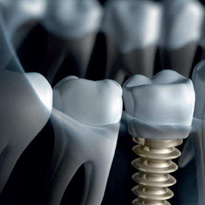 RCS Diploma in Implant Dentistry (Dip Imp RCSEd) Examination Preparation and Implant Update