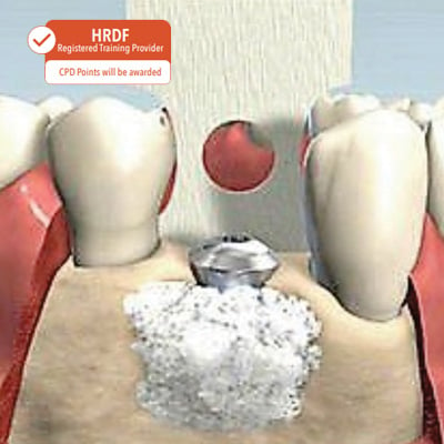 Guided Bone Regeneration and Peri-Implant Tissue Health A Hands-on Workshop