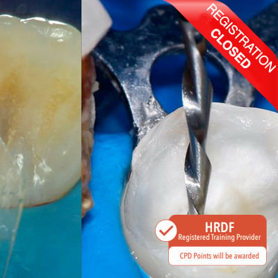Mastering The Art of Composite Resin for Posterior and Endodontic Treated Teeth